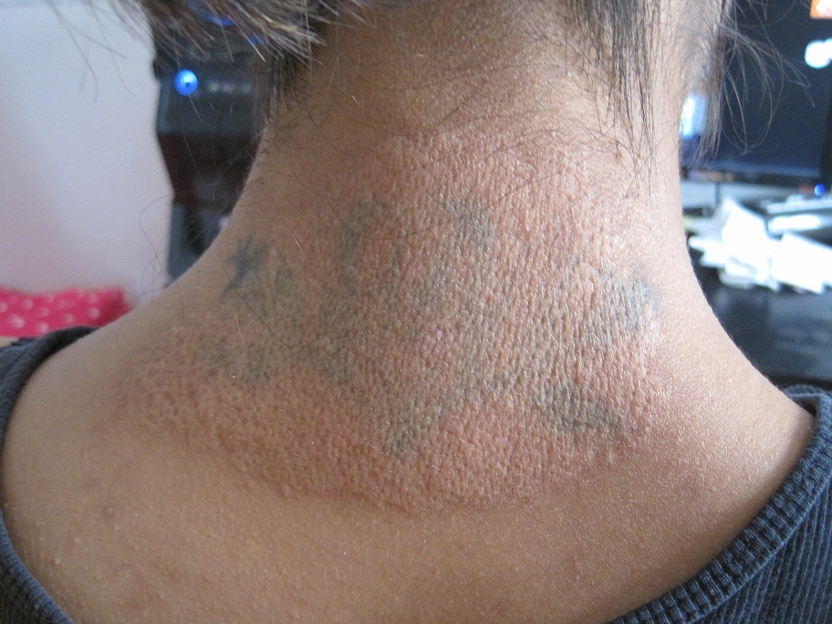 Một nạn nh&acirc;n của việc x&oacute;a xăm tại nh&agrave;