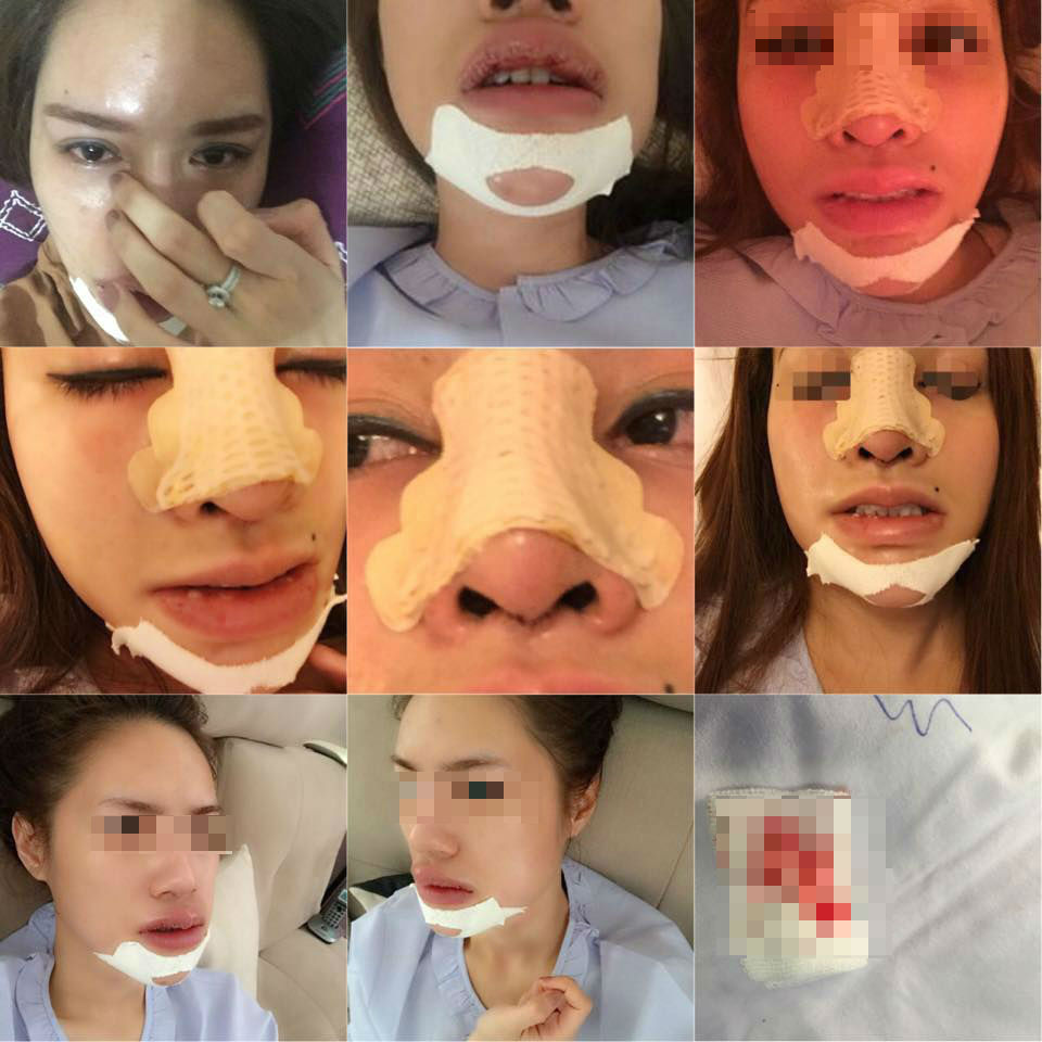 Bệnh nh&acirc;n khốn khổ v&igrave; biến chứng sau khi ti&ecirc;m filler