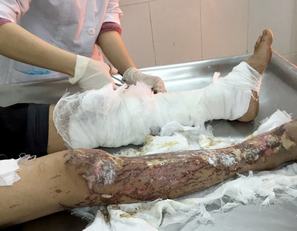 Chị T. bị tạt axit do người t&igrave;nh 65 tuổi ghen tu&ocirc;ng t&igrave;nh cảm