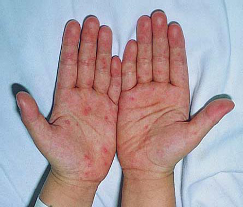 Dấu hiệu đặc trưng của bệnh tay ch&acirc;n miệng l&agrave; ph&aacute;t ban dạng phỏng nước ở l&ograve;ng b&agrave;n tay, l&ograve;ng b&agrave;n ch&acirc;n
