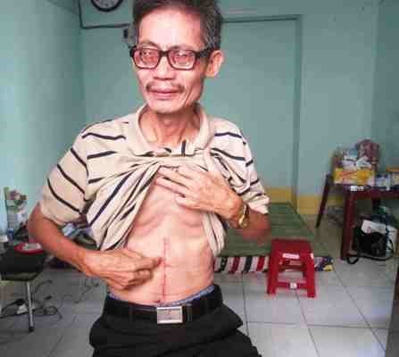 &Ocirc;ng S&aacute;u chỉ vết thương v&igrave; bị con ruột đ&acirc;m