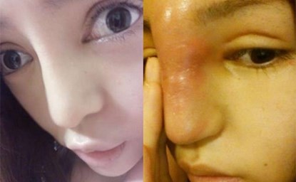 Chiếc mũi đ&aacute;ng sợ của c&ocirc; g&aacute;i l&agrave; di chứng sau phẫu thuật thẩm mỹ thất bại