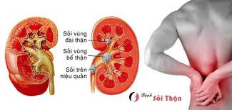Coi chừng sỏi thận từ những th&oacute;i quen tưởng b&igrave;nh thường  - ảnh 1