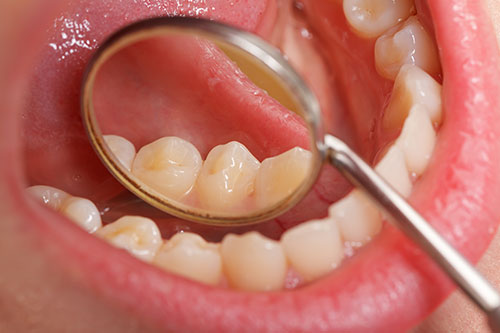 Bạn đ&atilde; biết c&aacute;ch ph&ograve;ng tr&aacute;nh bệnh ung thư miệng?