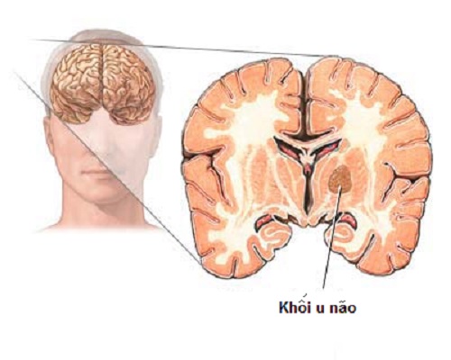 Bạn đ&atilde; biết những nguy&ecirc;n nh&acirc;n g&acirc;y bệnh ung thư n&atilde;o h&agrave;ng đầu?