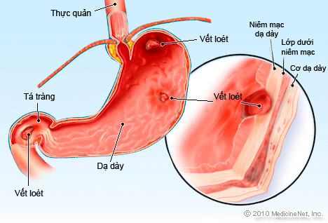 Chữa vi&ecirc;m lo&eacute;t dạ d&agrave;y đơn giản với nguy&ecirc;n liệu tại vườn nh&agrave; - ảnh 1
