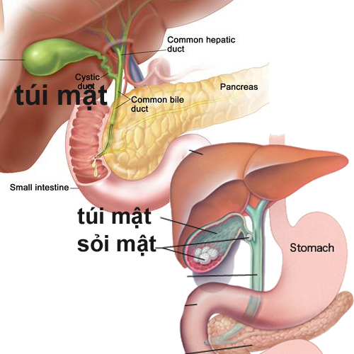 đ&aacute;nh tan sỏi mật bằng loại quả d&acirc;n d&atilde;