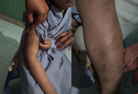 Những vết bầm t&iacute;m tay v&agrave; ch&acirc;n của ch&aacute;u H. l&agrave;m dấy l&ecirc;n nghi vấn trẻ bị bạo h&agrave;nh d&atilde; man tại cơ sở tu tại gia