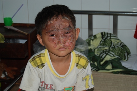 Khu&ocirc;n mặt ch&aacute;u Huy - trẻ bị bỏng nặng v&igrave; chơi đ&egrave;n lồng trung thu khiến kh&ocirc;ng &iacute;t người x&oacute;t xa