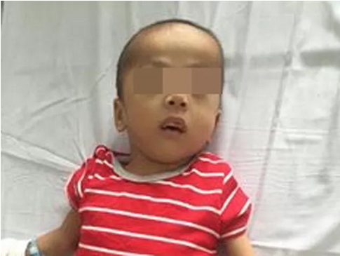 Một trường hợp trẻ em bị ch&oacute; cắn nghi&ecirc;m trọng kh&aacute;c l&agrave; b&eacute; 5 tuổi bị ch&oacute; cắn l&igrave;a dương vật