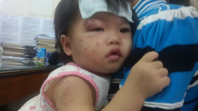 B&eacute; một tuổi bị c&agrave;o cấu chi ch&iacute;t tại nh&agrave; trẻ tư