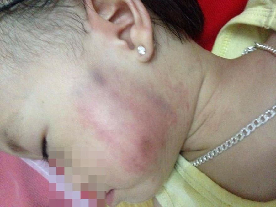 B&eacute; g&aacute;i với nhiều vết bầm t&iacute;m tr&ecirc;n gương mặt l&agrave;m nhiều người nghi ngờ đ&atilde; xảy ra trường hợp trẻ mầm non bị bạo h&agrave;nh