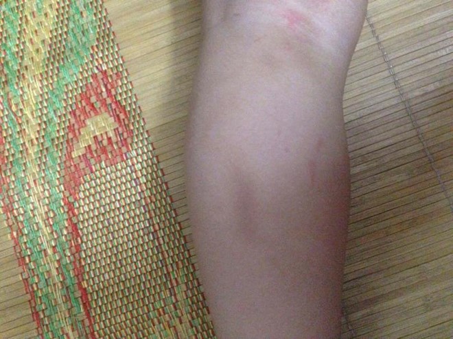 Trong khi gia đ&igrave;nh cho rằng trẻ bị bạo h&agrave;nh, c&aacute;c c&ocirc; gi&aacute;o khẳng định b&eacute; bị bầm t&iacute;m đến vậy l&agrave; do bị ng&atilde;