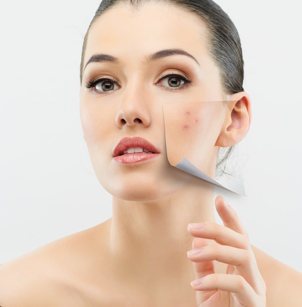 L&agrave;m da bị mụn trứng c&aacute; sẽ được chăm s&oacute;c ho&agrave;n hảo với phương ph&aacute;p trị mụn bằng mật ong