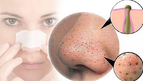 C&aacute;ch trị mụn đầu đen đơn giản, hiệu quả  - ảnh 2