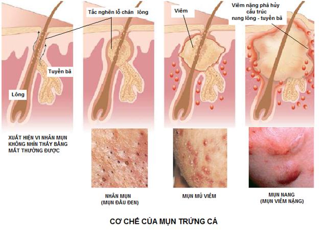 Mụn trứng c&aacute; c&oacute; rất nhiều thể loại, kh&ocirc;ng thể chỉ nh&igrave;n nghe biểu hiện m&agrave; chuẩn đo&aacute;n ch&iacute;nh x&aacute;c được bệnh