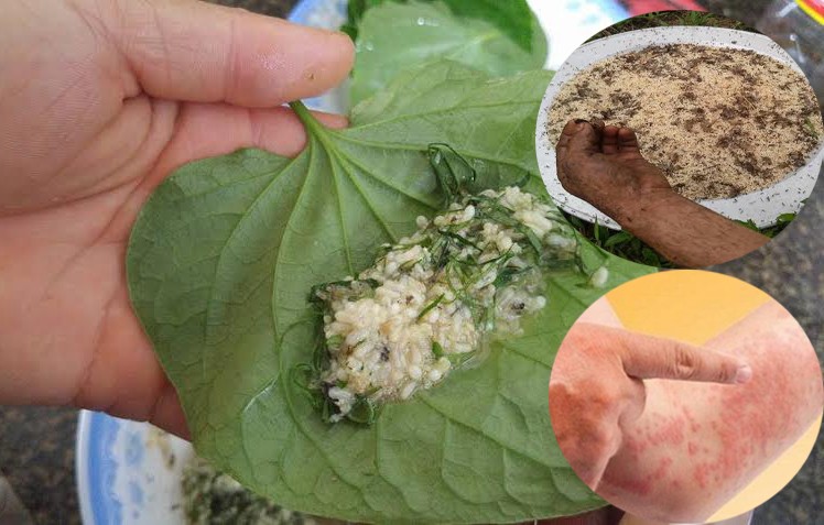 Sưng mặt v&igrave; ăn ...trứng kiến 