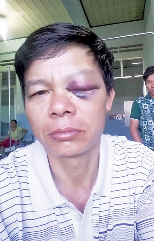 Mắt tr&aacute;i của kiểm l&acirc;m Phạm Minh Tiến sưng h&uacute;p, bầm đen v&igrave; bị h&agrave;nh hung