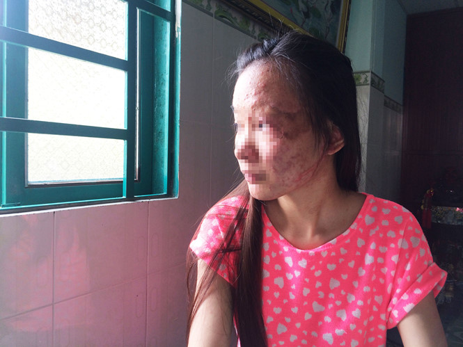 Những nạn nh&acirc;n bị tạt axit lu&ocirc;n phải chịu những di chứng đau đớn suốt đời