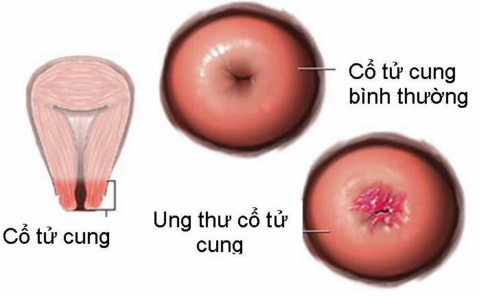 Nguy cơ ung thư cổ tử cung chiếm 51.9% số ca tử vong của phụ nữ tr&ecirc;n thế giới mỗi năm