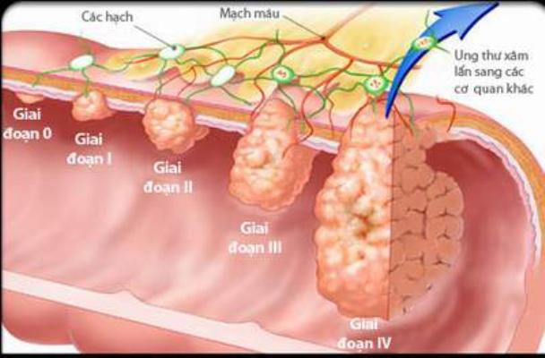 Nguy cơ ung thư dạ d&agrave;y c&oacute; thể xảy ra cho mọi đối tượng ở mọi lứa tuổi