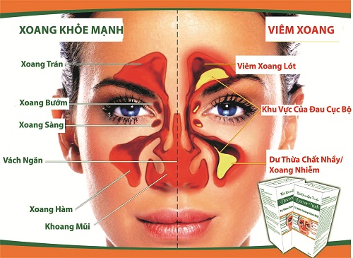 vi&ecirc;m xoang, vi&ecirc;m mũi