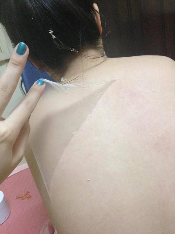 Da lưng sau khi lột bị đỏ ửng v&igrave; k&iacute;ch ứng (ảnh: Tuệ Minh)