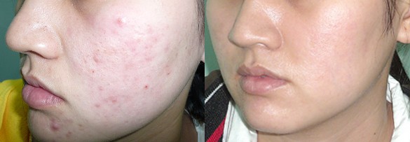 thuốc trị mụn, g&acirc;y qu&aacute;i thai, 13Win21 con - Tri ân hội viên mỗi tháng 2000 tỷ