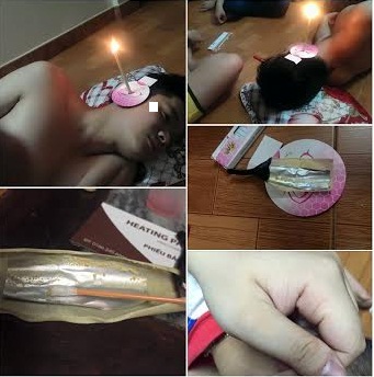 Lấy r&aacute;y tai bằng lửa: Coi chừng điếc!