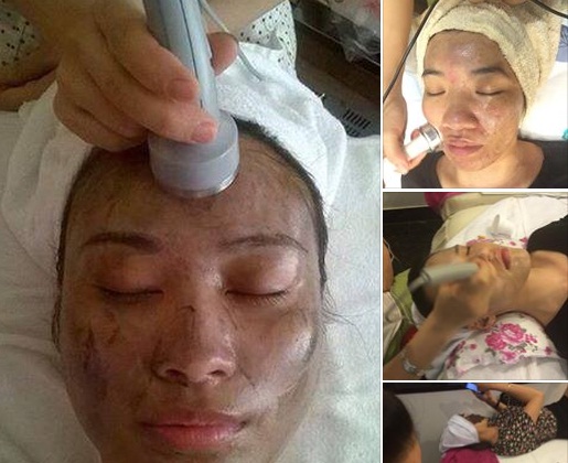 Qu&aacute; tr&igrave;nh h&uacute;t ch&igrave; tr&ecirc;n da mặt cho kh&aacute;ch h&agrave;ng tại thẩm mỹ viện được quảng c&aacute;o tr&ecirc;n MXH