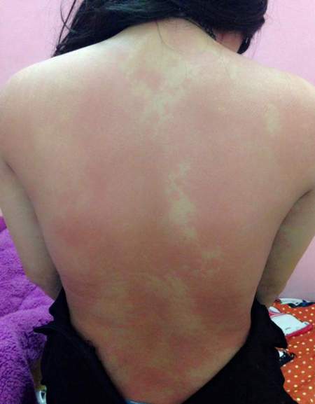 Bội nhiễm da v&igrave; kem tan mỡ