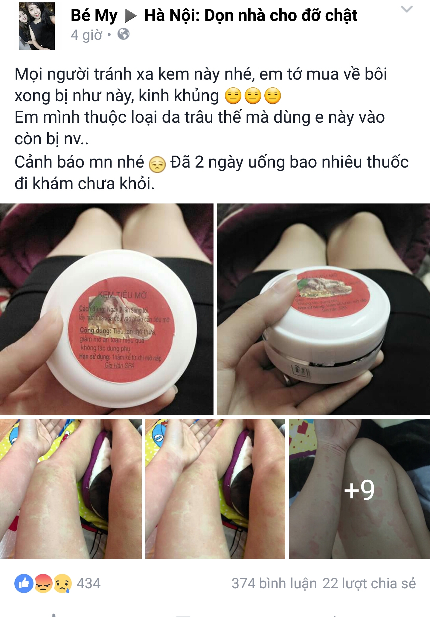 Bội nhiễm da v&igrave; kem tan mỡ