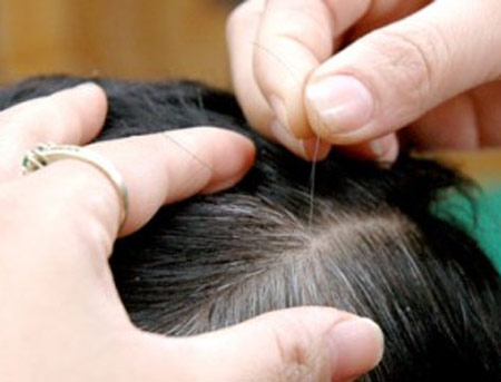 vị tr&iacute; t&oacute;c bạc cũng gi&uacute;p ch&uacute;ng ta đo&aacute;n bệnh cơ thể