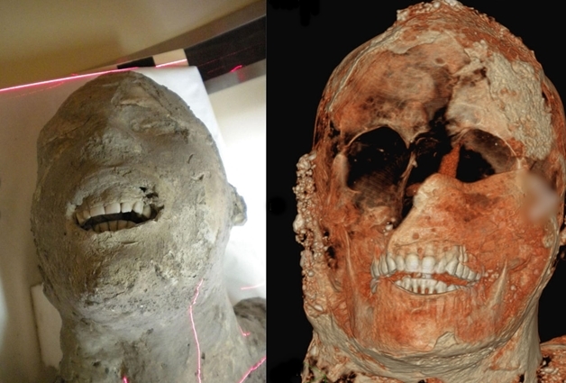 Ảnh chụp cắt lớp của 1 x&aacute;c ướp thạch cao Pompeii