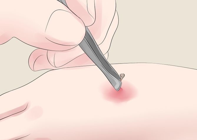 Sơ cứu vết ong đốt