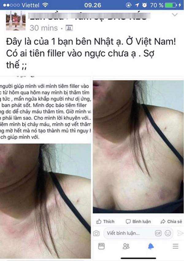 Một c&ocirc; g&aacute;i sau sau khi ti&ecirc;m filler l&agrave;m đẹp: Ngực căng tức, bầm t&iacute;m