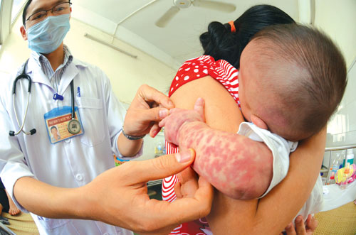 Nhận biết trẻ bị sởi