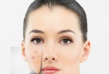 Những sản phẩm trị mụn hiệu quả giá dưới 200.000 đồng