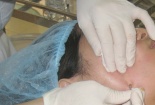 Dùng kim nặn mụn có nguy cơ lây nhiễm HIV, viêm gan siêu vi