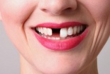 Ham rẻ làm răng sứ không đảm bảo chất lượng cẩn thận hỏng cả hàm răng