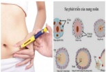 Tiêm thuốc kích trứng và những biến chứng có thể gây tử vong 