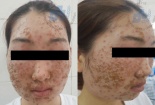 Dùng bột rửa mặt mua trên mạng cô gái 22 tuổi viêm da mặt, chảy dịch vàng