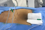 Tiêm thuốc không rõ nguồn gốc vào cột sống từ 'thầy lang vườn' gây biến chứng, nguy kịch