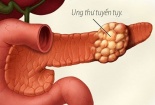 Phát hiện mới: Thuốc trị huyết áp có thể giúp kiềm chế ung thư tuyến tụy