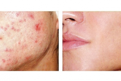 Cách điều trị mụn trứng cá