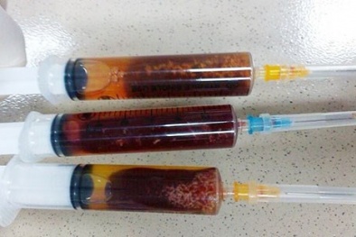 Bệnh sán hoành hành do ăn nhiều đồ sống
