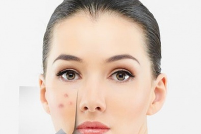 Những sản phẩm trị mụn hiệu quả giá dưới 200.000 đồng
