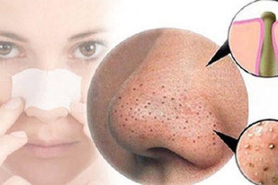 Bí quyết trị mụn đầu đen đơn giản, hiệu quả 