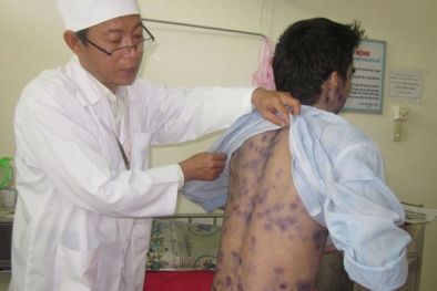 Tác nhân chính gây ra bệnh thủy đậu