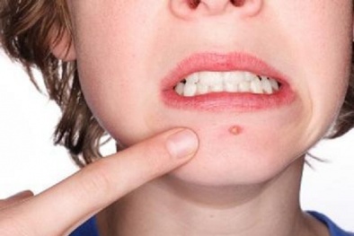 Công thức trị mụn rộp hiệu quả từ thiên nhiên